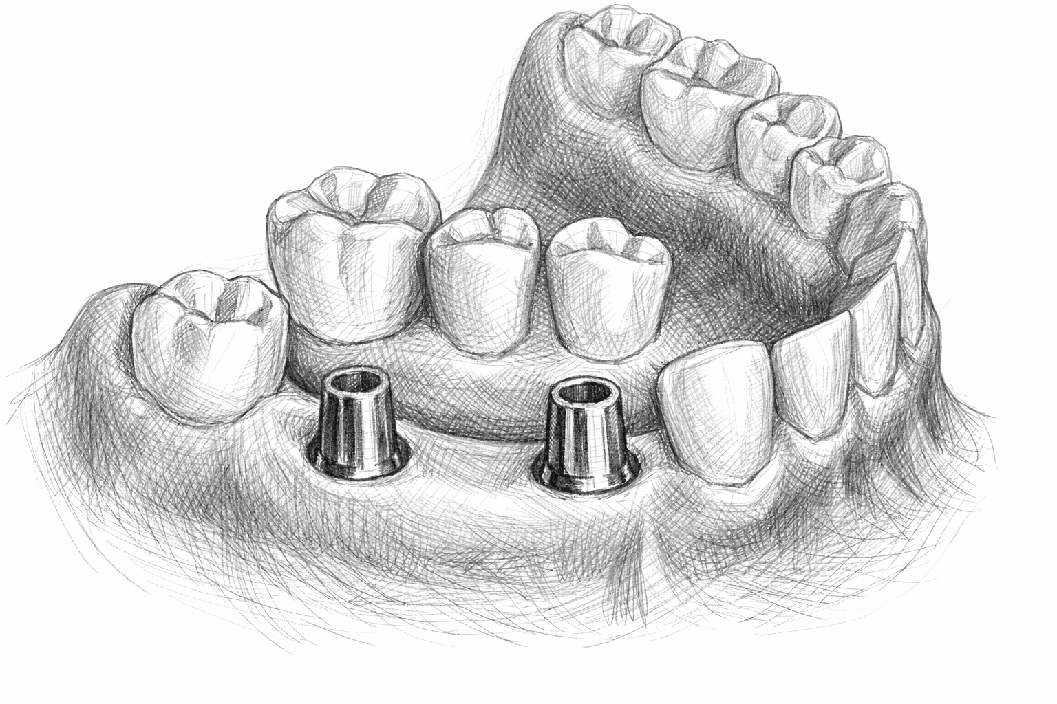 Implantatgetragener Zahnersatz Zahnarzt Berlin Lichtenberg | Zahnarztpraxis Dr. Anne Kehler in Lichtenberg Bild Implantatgetragener Zahnersatz Zahnarzt Berlin Lichtenberg