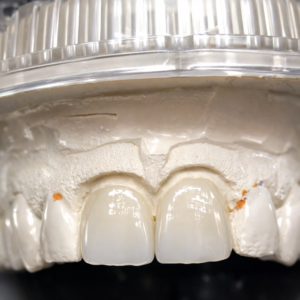 Bild Ästhetische Zahnmedizin Zahnersatz Veneers Zahnarzt Berlin Lichtenberg
